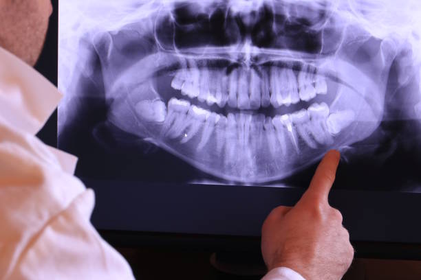 Best Emergency Wisdom Tooth Extraction in Mableton, GA
